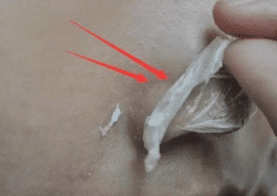 鼻头螨虫有什么药可以根治,鼻头上有螨虫用什么药