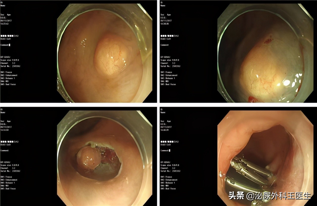 直肠粘膜下肿物处理,直肠肿物怎么办