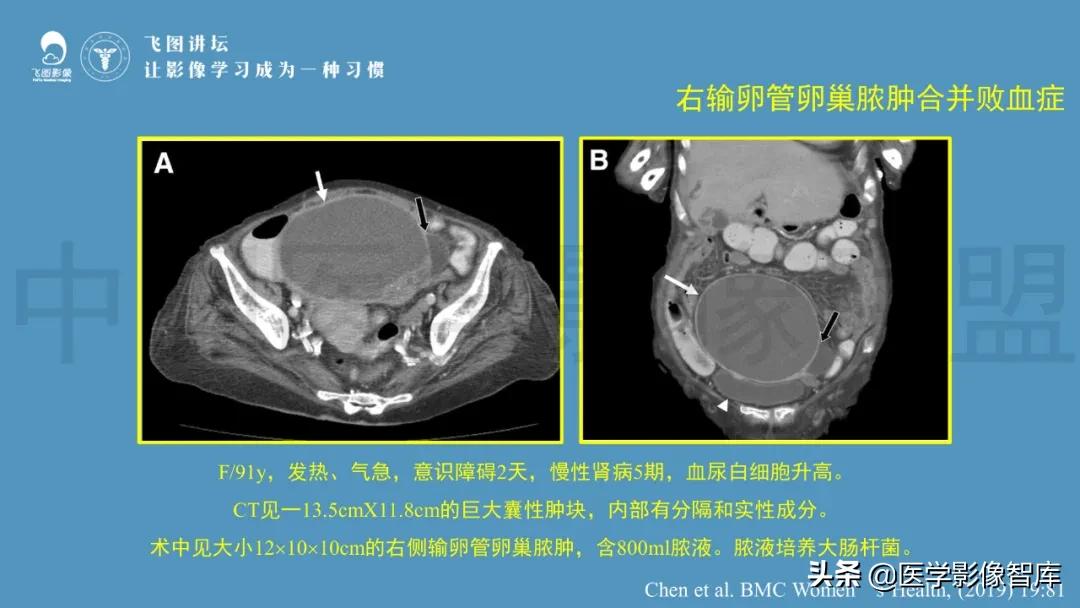 子宫解剖结构输卵管和卵巢位置,子宫附件ct影像学正常解剖表现