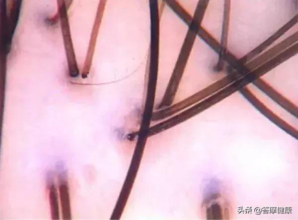 掉发头发少发际线高是什么原因,发际线起皮干燥有碎屑什么原因