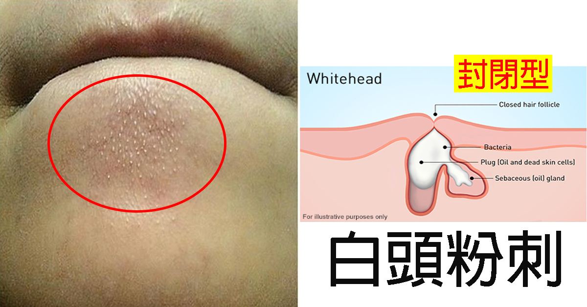 下巴长粉刺如何调理好得快,下巴长粉刺的原因和改善方法女生