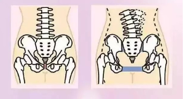 产后骨盆修复的最佳方法,剖腹产做骨盆修复还是盆底肌修复