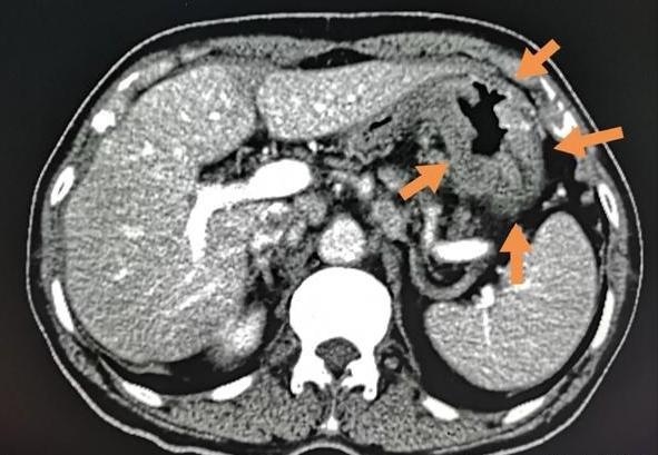 肚子天天咕咕响是肠癌的前兆吗,肚子老是咕噜咕噜响是肠癌表现吗
