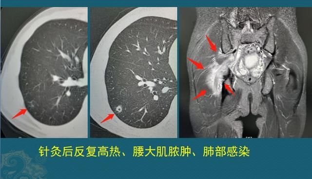 化脓性肺炎，硬扛3天不吃抗生素必后悔，这个细菌专治各种不服
