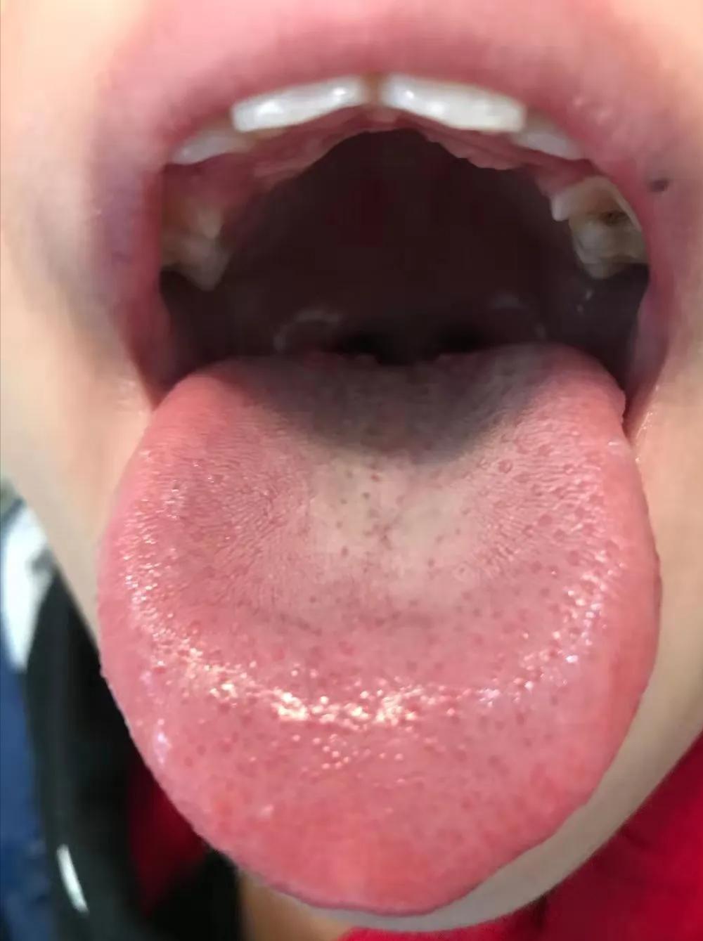 张景明治疗手足癣的中药方,手足癣单方大全