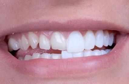 冷光美白牙齿危害亲身经历,牙齿美白科普篇