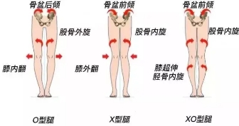深度长文400篇,骨盆修复手法调理x型腿