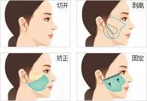 线雕热玛吉拉皮超声刀的区别,热玛吉超声刀线雕后遗症有多严重