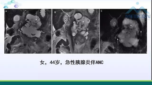 急性胰腺炎的护理措施,急性胰腺炎影像与临床