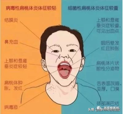 扁桃体炎经过抗炎治疗几天能好,扁桃体发炎中医辨证治疗