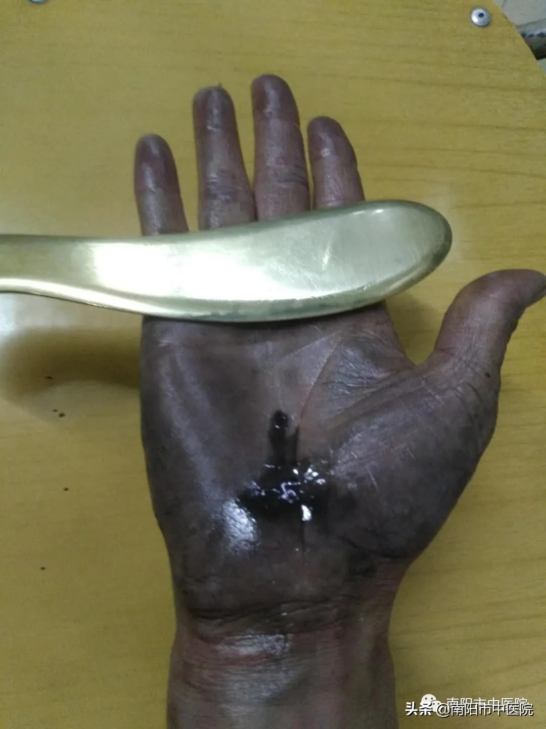 南阳市中医院开展多种中医特点治疗项目——虎符铜砭刮痧