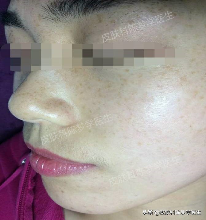 色斑和褐斑,根治面部黑褐斑的方法