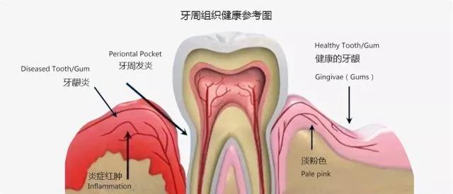 牙齿残根算牙齿缺失吗,口腔有缺失牙不处理好吗