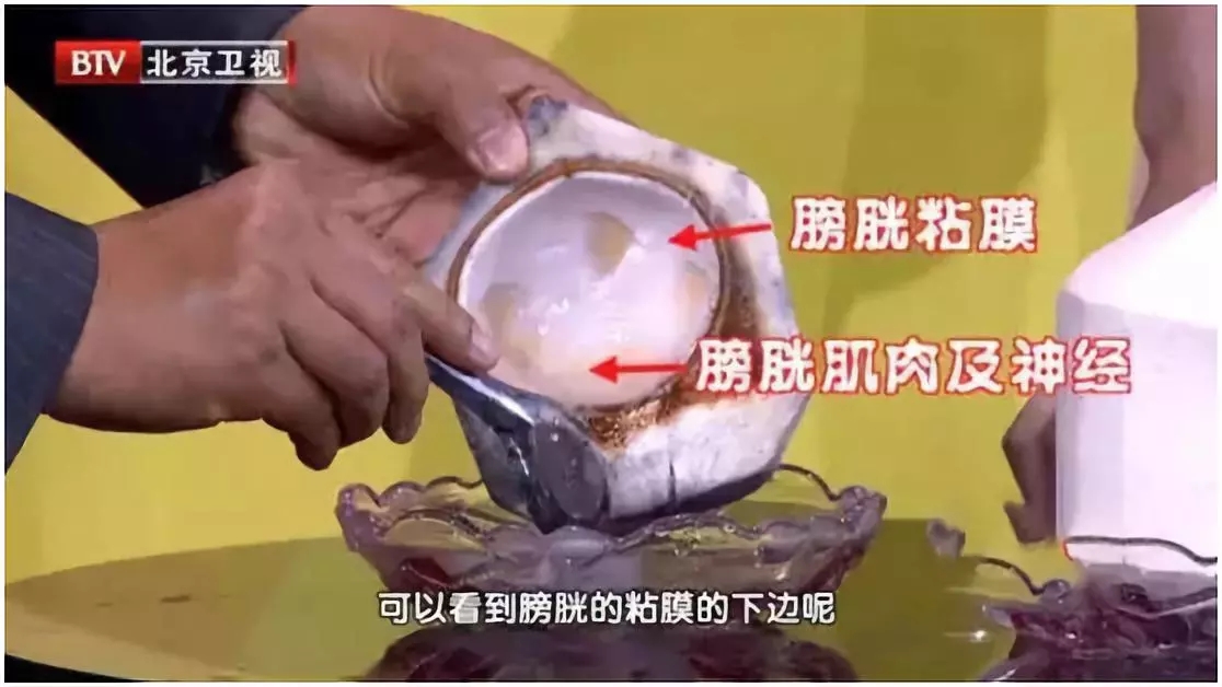 膀胱癌症状无痛血尿,膀胱癌血尿为什么是无痛间歇性