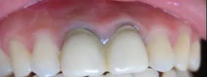 明星都做了全烤瓷牙吗,明星做烤瓷牙是要拔掉原来的牙吗