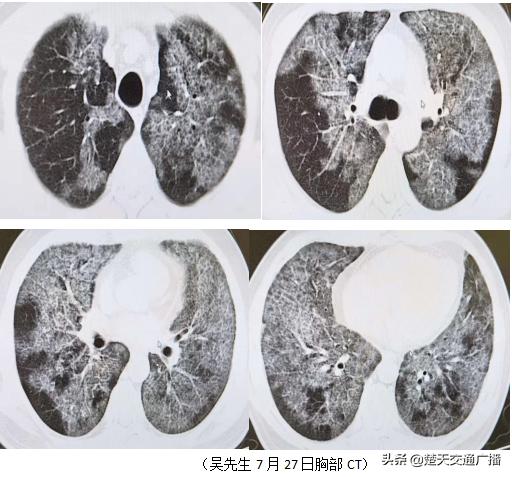 胸闷气喘半年，男子肺里洗出19升“牛奶”