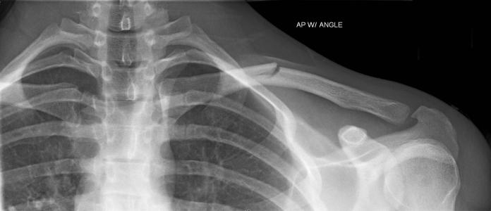 锁骨骨折为啥有人恢复快有人慢,锁骨骨折十大后遗症