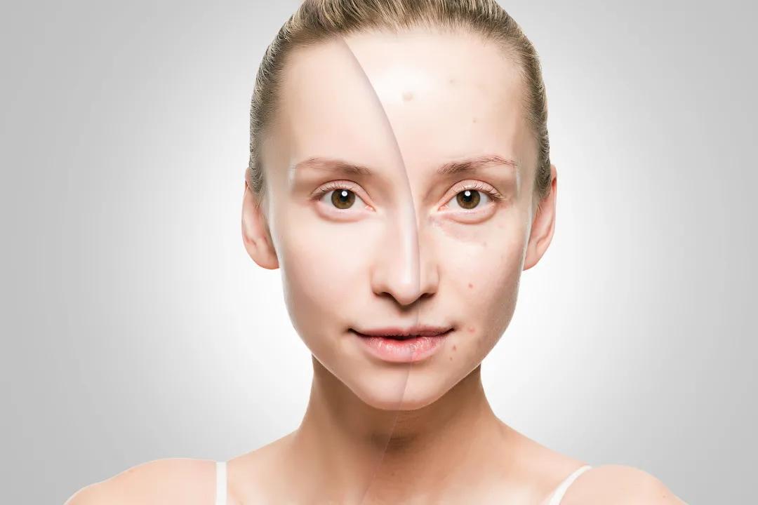 下巴额头反复长痘怎么调理,额头和后背长痘是什么原因