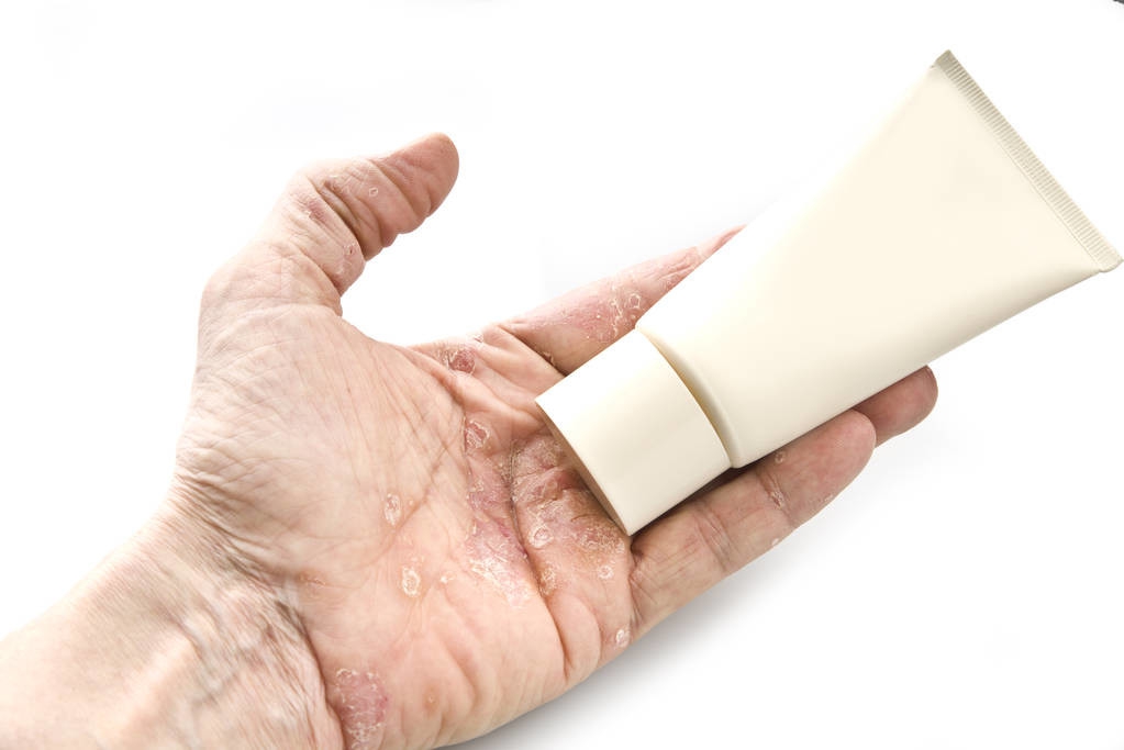 小儿牛皮癣的症状和治疗方法,头皮牛皮癣有什么好的治疗方法