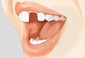 缺一颗上牙在边上镶活牙行吗,单颗牙缺失一个月不补可以吗