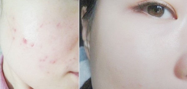 表面的痘印怎么祛痘最有效,祛除痘印祛痘坑最有效的方法