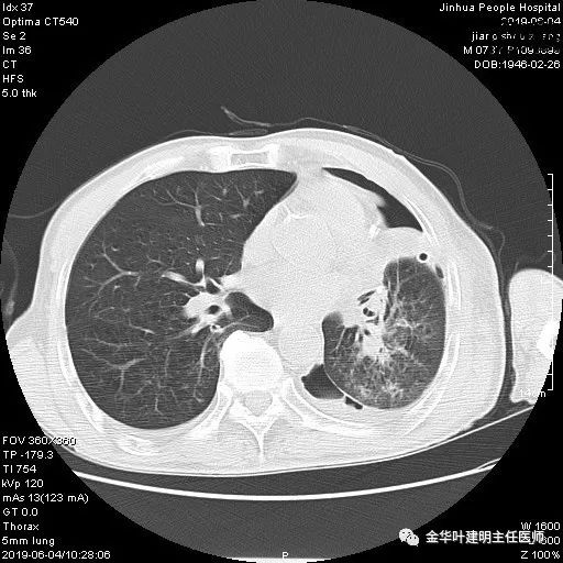 手术引起乳糜胸,有没有做了肺结节手术后是误诊的