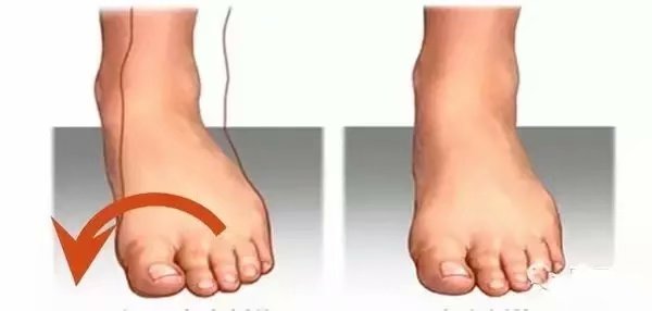 扁平足穿什么鞋都痛吗,扁平足穿什么鞋可以矫正