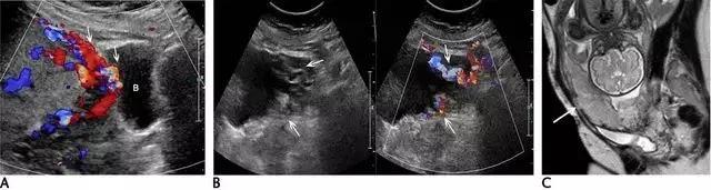 临床上最常见的异常胎盘,前置胎盘和低置胎盘超声