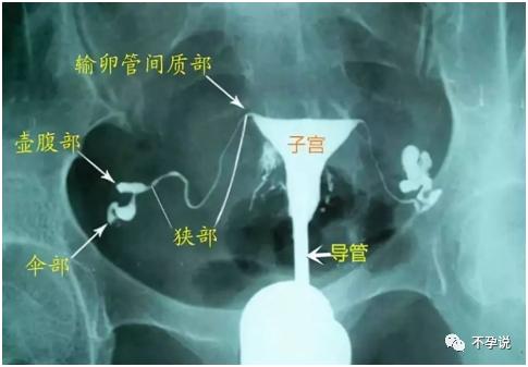 输卵管造影vs输卵管通液