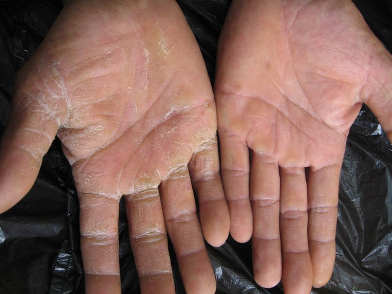 手足癣干裂脱皮怎么治,湿疹和手足癣如何一起治疗