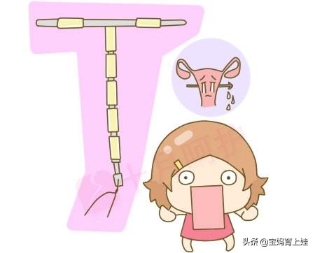 树袋宝宝：避孕环危害女性健康？一起来了解一下