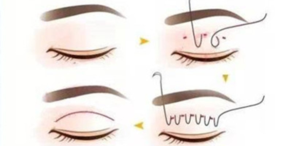 爱美整形割双眼皮,爱美双眼皮