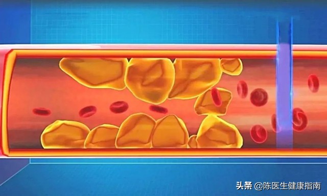 心梗医生说放支架,低密度脂蛋白多高容易脑梗心梗