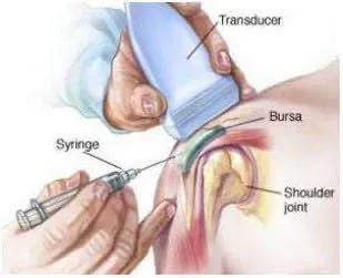 漳浦县医院疼痛科,超声引导下疼痛微创治疗