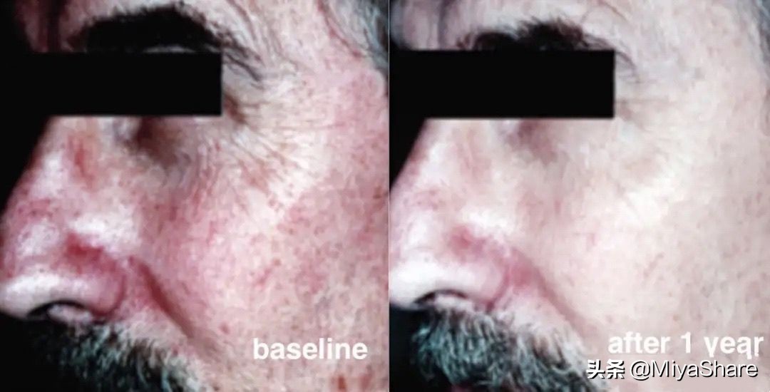 敏感肌抗老淡纹紧致精华,抗老精华干皮肤敏感