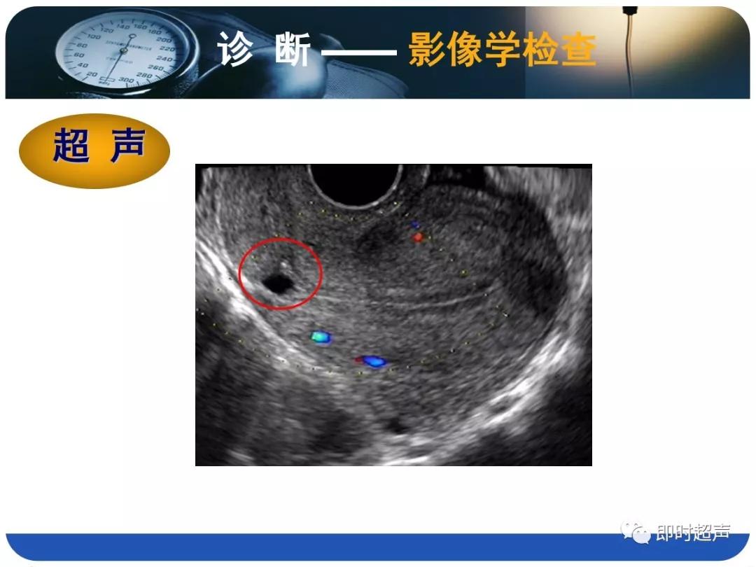 孕妇剖宫产瘢痕憩室,剖宫产瘢痕憩室息肉