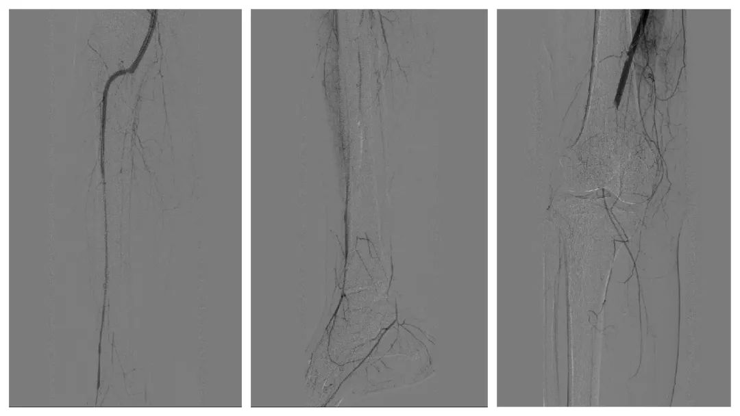 动脉血管堵用什么药,动脉和静脉血管堵哪个严重些