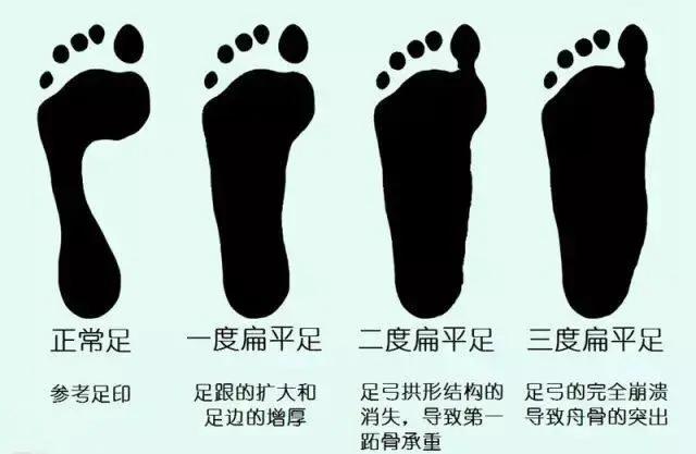 双脚外侧鞋底磨损严重,双脚鞋底磨损程度不同