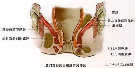肛周脓肿拖延一周,如果早期发现肛周脓肿怎么治疗