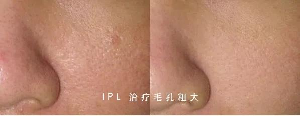 脸部脱毛和光子嫩肤可以一起做吗,油皮光子嫩肤护肤方法