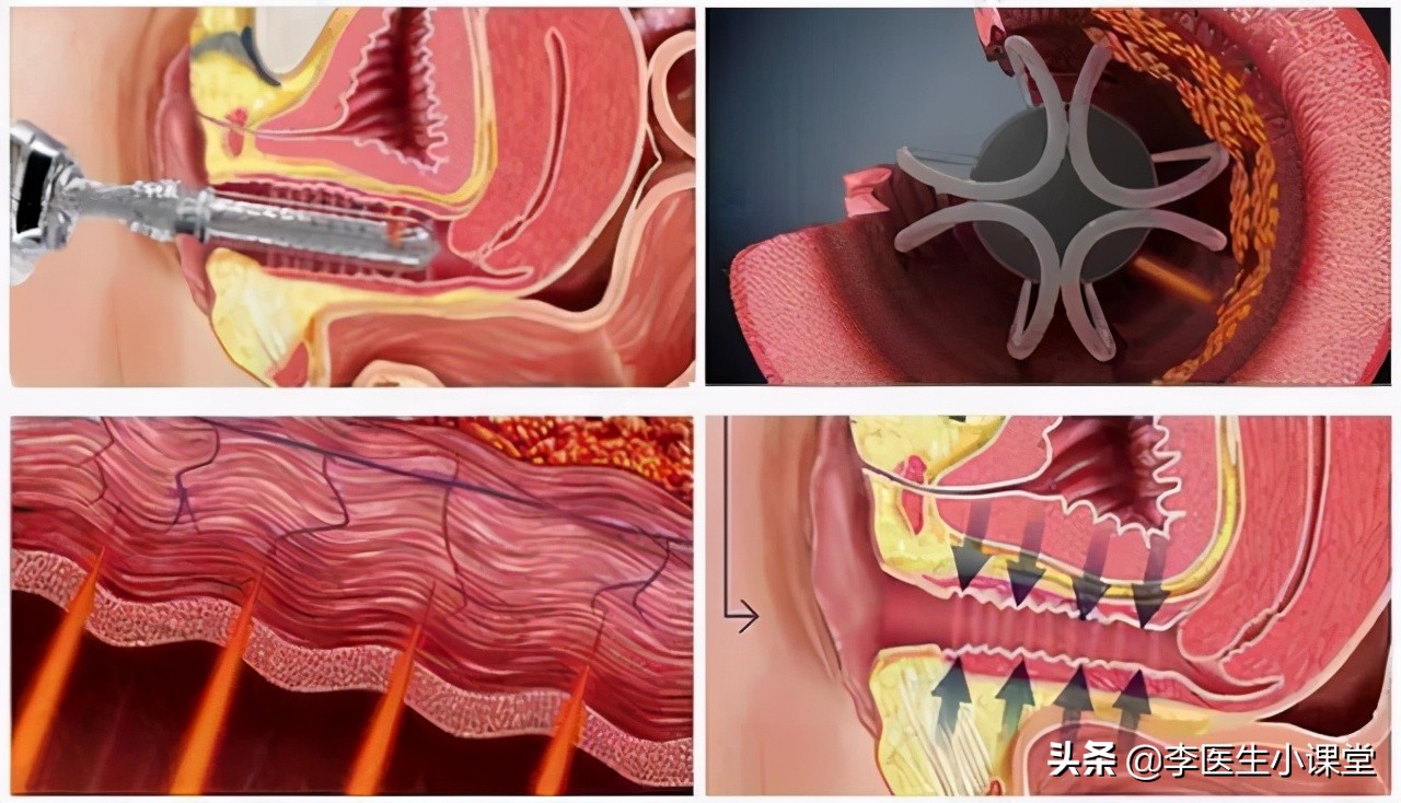 45岁左右的女性，出现各种疼痛，可能是更年期问题，该如何补钙