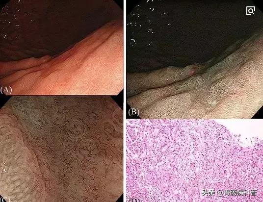 科普胶囊内镜和电子内镜该怎么选,胶囊内镜与无痛胃肠镜区别