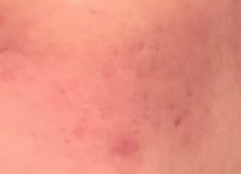 激光微创治疗后注意事项,做完有创激光怎么保湿