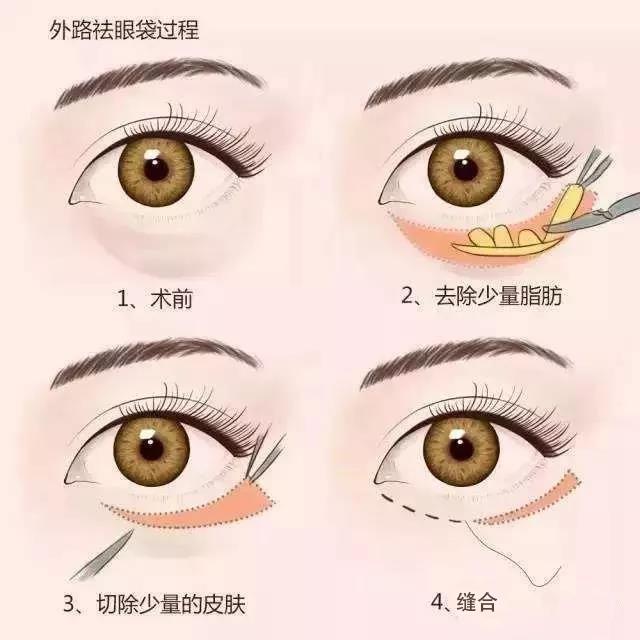 熬夜眼袋八字纹,熬夜带来的眼袋能去除吗