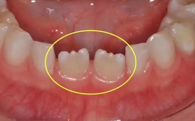 6-12岁换牙怎么换一口好牙,7岁换牙期注意事项怎么才整齐