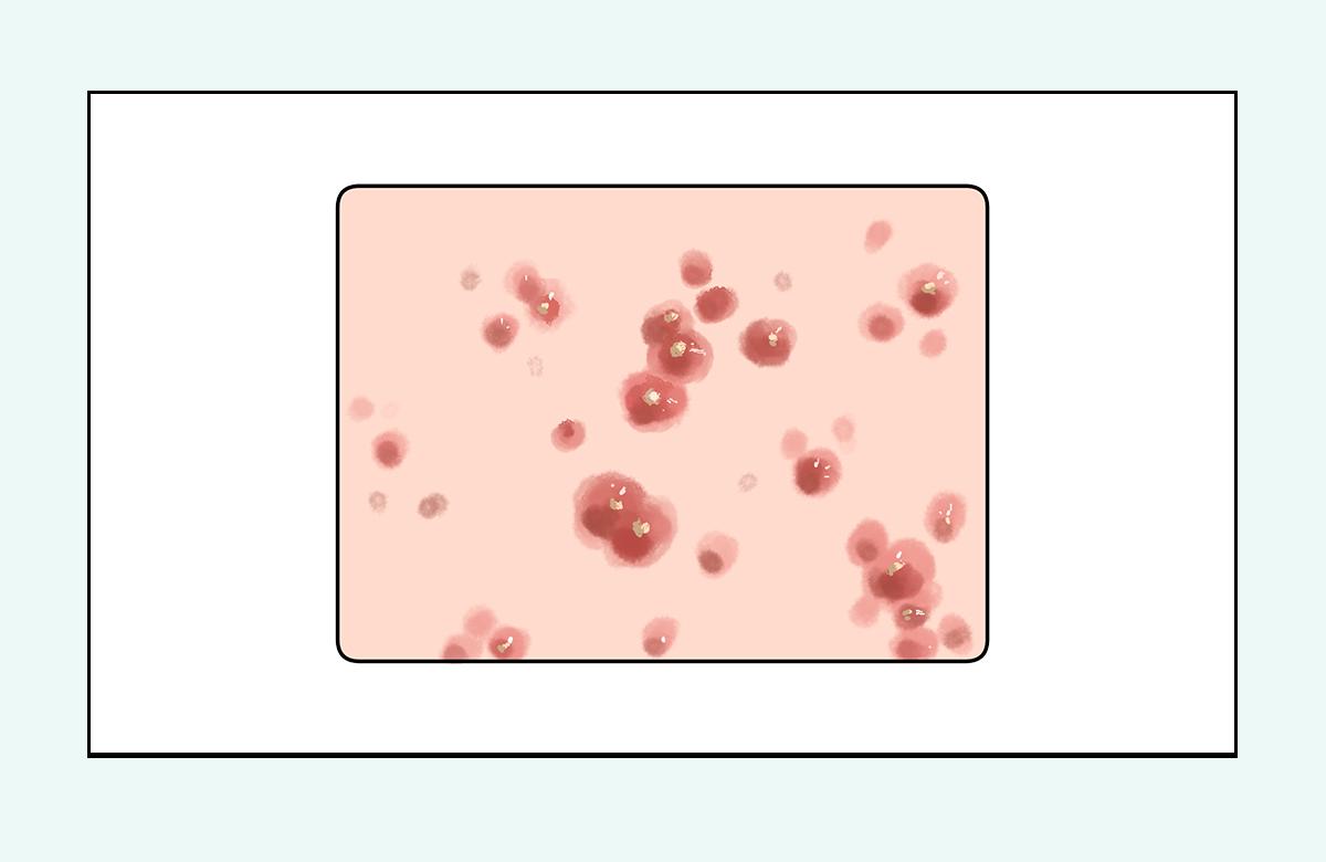 脸上的红疙瘩疼是什么原因,脸上的各种疙瘩