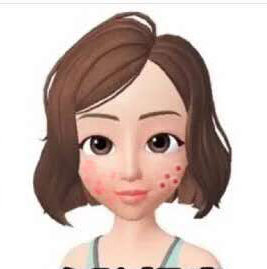 鼻翼两侧和下巴长痘什么原因引起,脸颊两边长痘是什么原因该怎么办