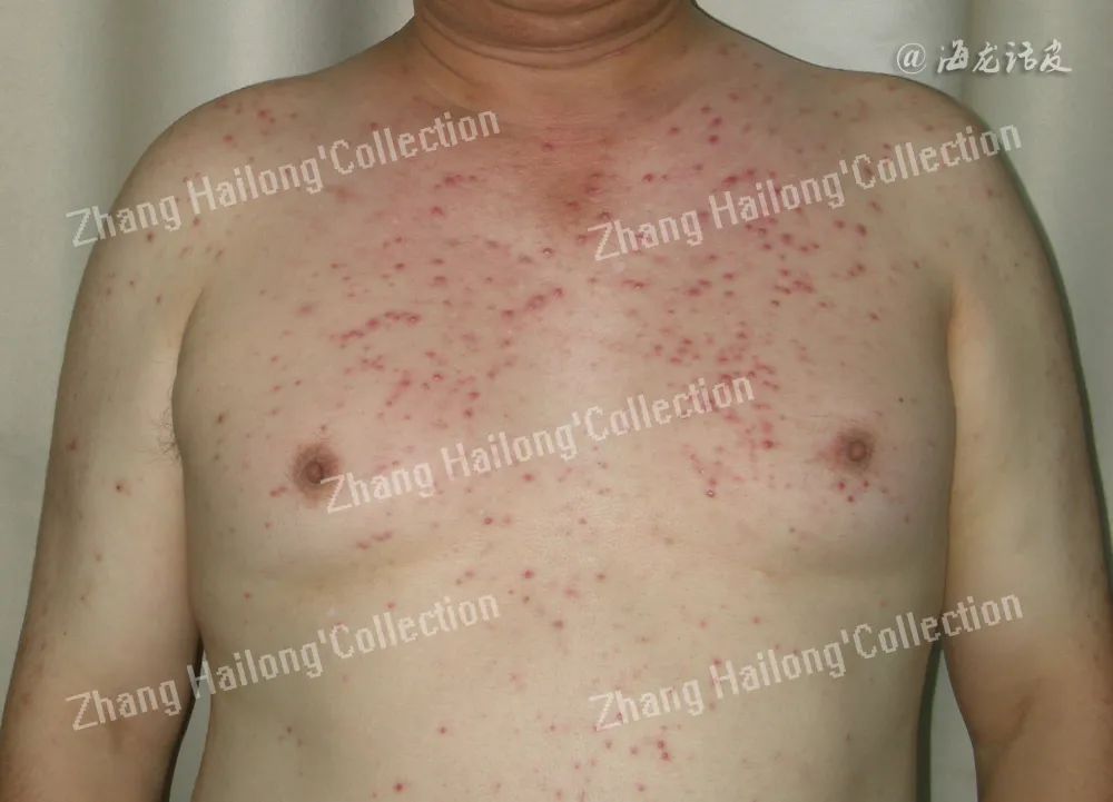 胸口长马拉色菌毛囊炎,前胸后背长满马拉色菌毛囊炎