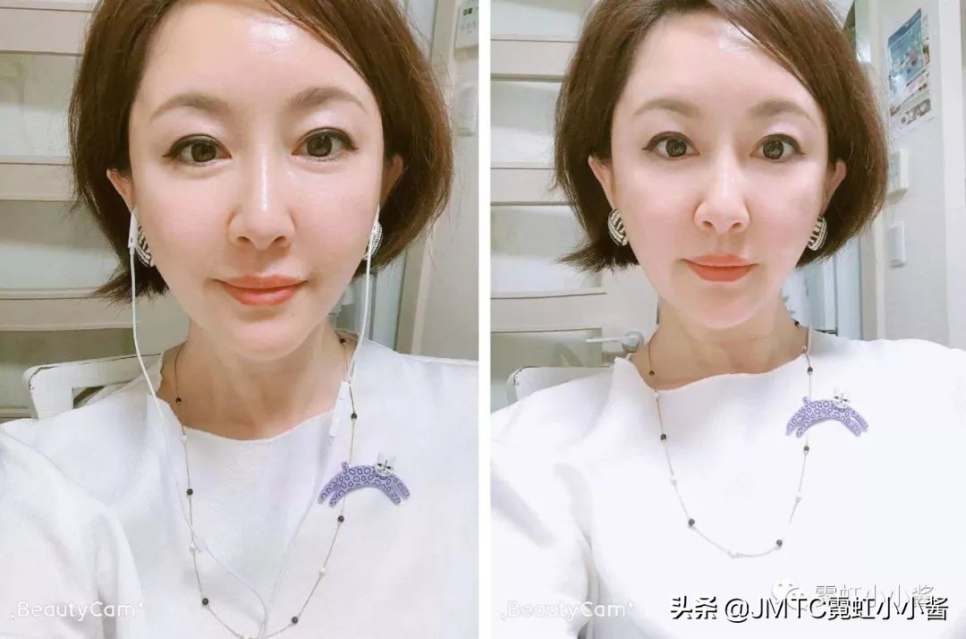 记录翻译小姐姐日本打溶脂针，肉脸变骨感脸全过程｜日本医美