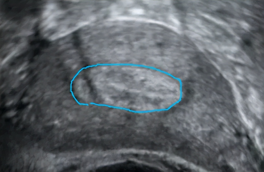 四维超声能看出宫腔粘连吗,做超声能看出来宫腔粘连吗